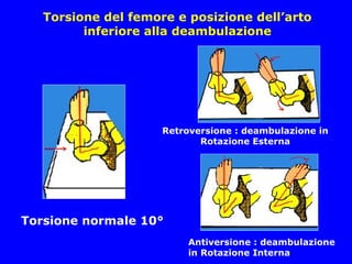 Torsione del femore e posizione dell’arto
inferiore alla deambulazione
Torsione normale 10°
Retroversione : deambulazione in
Rotazione Esterna
Antiversione : deambulazione
in Rotazione Interna
 