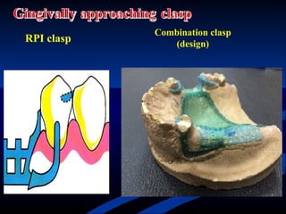 01-partial denture framework designs .ppt