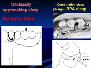 01-partial denture framework designs .ppt