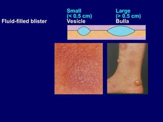 Bulla Photo Diagnosis of skin disorders and how to deal.ppt