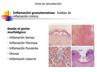 TIPOS DE INFLAMACIÓN Inflamación granulomatosa:  Subtipo de inflamación crónica. <ul><li>Desde el punto morfológico: </li>...