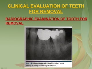 CLINICAL EVALUATION OF TEETH
FOR REMOVAL
RADIOGRAPHIC EXAMINATION OF TOOTH FOR
REMOVAL
 