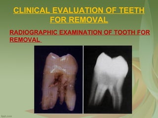 CLINICAL EVALUATION OF TEETH
FOR REMOVAL
RADIOGRAPHIC EXAMINATION OF TOOTH FOR
REMOVAL
 