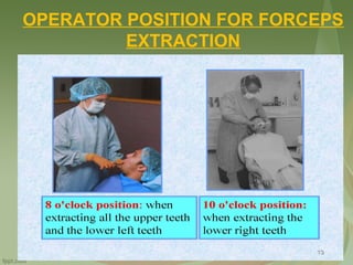 OPERATOR POSITION FOR FORCEPS
EXTRACTION
 