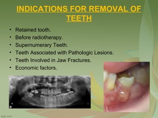 INDICATIONS FOR REMOVAL OF
TEETH
• Retained tooth.
• Before radiotherapy.
• Supernumerary Teeth.
• Teeth Associated with Pathologic Lesions.
• Teeth Involved in Jaw Fractures.
• Economic factors.
 