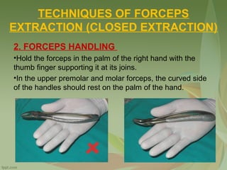 TECHNIQUES OF FORCEPS
EXTRACTION (CLOSED EXTRACTION)
2. FORCEPS HANDLING
•Hold the forceps in the palm of the right hand with the
thumb finger supporting it at its joins.
•In the upper premolar and molar forceps, the curved side
of the handles should rest on the palm of the hand.
 