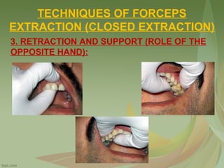 TECHNIQUES OF FORCEPS
EXTRACTION (CLOSED EXTRACTION)
3. RETRACTION AND SUPPORT (ROLE OF THE
OPPOSITE HAND):
 
