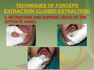 TECHNIQUES OF FORCEPS
EXTRACTION (CLOSED EXTRACTION)
3. RETRACTION AND SUPPORT (ROLE OF THE
OPPOSITE HAND):
 