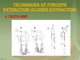 TECHNIQUES OF FORCEPS
EXTRACTION (CLOSED EXTRACTION)
4. TOOTH GRIP
 