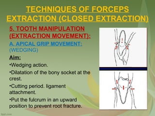 TECHNIQUES OF FORCEPS
EXTRACTION (CLOSED EXTRACTION)
5. TOOTH MANIPULATION
(EXTRACTION MOVEMENT):
A. APICAL GRIP MOVEMENT:
(WEDGING)
Aim:
•Wedging action.
•Dilatation of the bony socket at the
crest.
•Cutting period. ligament
attachment.
•Put the fulcrum in an upward
position to prevent root fracture.
 