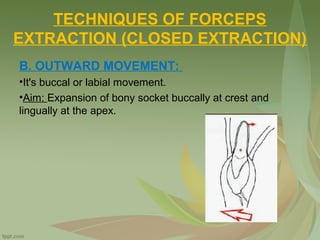 TECHNIQUES OF FORCEPS
EXTRACTION (CLOSED EXTRACTION)
B. OUTWARD MOVEMENT:
•It's buccal or labial movement.
•Aim: Expansion of bony socket buccally at crest and
lingually at the apex.
 