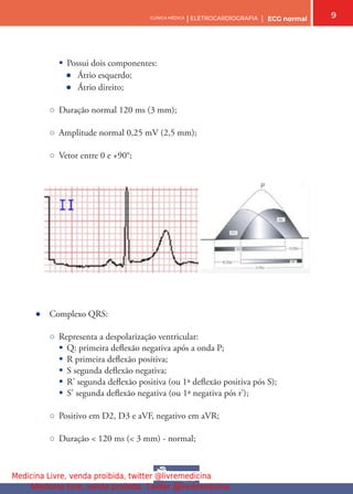 9
CLÍNICA MÉDICA | ELETROCARDIOGRAFIA | ECG normal
§ Possui dois componentes:
● Átrio esquerdo;
● Átrio direito;
○ Duração normal 120 ms (3 mm);
○ Amplitude normal 0,25 mV (2,5 mm);
○ Vetor entre 0 e +90°;
● Complexo QRS:
○ Representa a despolarização ventricular:
§ Q: primeira defexão negativa após a onda P;
§ R primeira defexão positiva;
§ S segunda defexão negativa;
§ R’ segunda defexão positiva (ou 1ª defexão positiva pós S);
§ S’ segunda defexão negativa (ou 1ª negativa pós r’);
○ Positivo em D2, D3 e aVF, negativo em aVR;
○ Duração < 120 ms (< 3 mm) - normal;
Medicina Livre, venda proibida, twitter @livremedicina
Medicina livre, venda proibida. Twitter @livremedicina
 