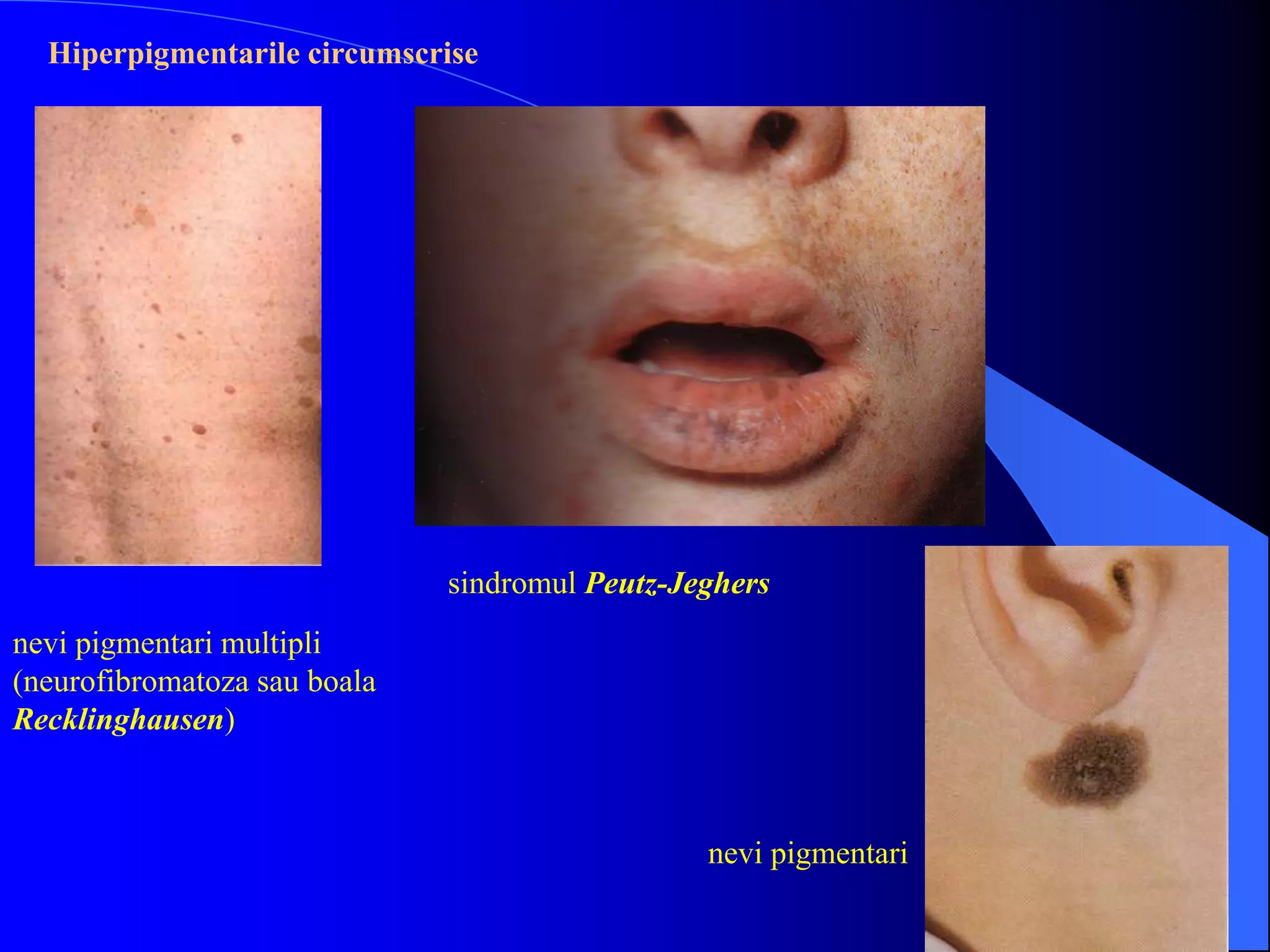 Piyoderma 01 - general - curs 5 - dermatologie.ppt