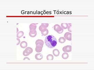 Granulações Tóxicas
.
 