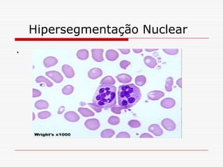 Hipersegmentação Nuclear
.
 