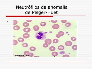 Neutrófilos da anomalia
       de Pelger-Huët
.
 