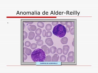 Anomalia de Alder-Reilly
.
 