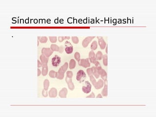 Síndrome de Chediak-Higashi
.
 