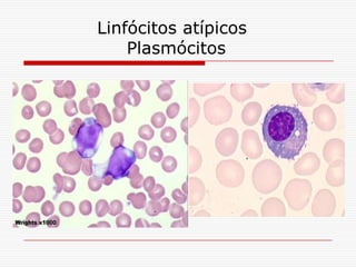 Linfócitos atípicos
        Plasmócitos
.
 