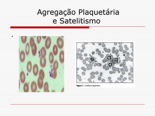 Agregação Plaquetária
        e Satelitismo
.
 