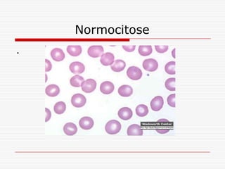 Normocitose
.
 