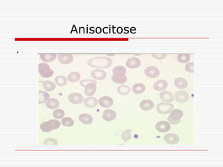 Anisocitose
.
 