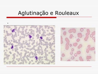 Aglutinação e Rouleaux
.
 
