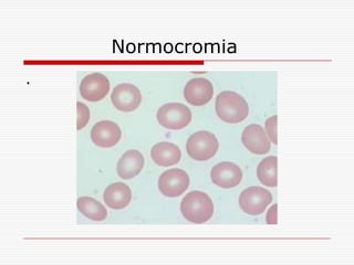Normocromia
.
 