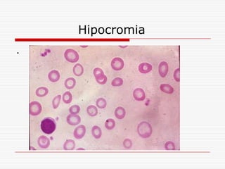 Hipocromia
.
 
