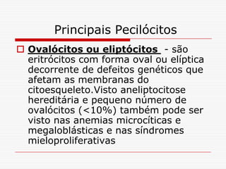 Principais Pecilócitos
 Ovalócitos ou eliptócitos - são
  eritrócitos com forma oval ou elíptica
  decorrente de defeitos genéticos que
  afetam as membranas do
  citoesqueleto.Visto aneliptocitose
  hereditária e pequeno número de
  ovalócitos (<10%) também pode ser
  visto nas anemias microcíticas e
  megaloblásticas e nas síndromes
  mieloproliferativas
 
