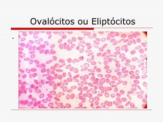 Ovalócitos ou Eliptócitos
.
 