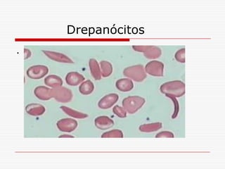 Drepanócitos
.
 