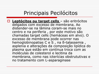 Principais Pecilócitos
 Leptócitos ou target cells – são eritrócitos
  delgados com excesso de membrana. Ao
  distender-se na lâmina coram-se mais no
  centro e na periferia , por este motivo são
  chamadas target cells (hemáceas em alvo). O
  excesso de membrana pode ocorrer nas
  hemoglobinopatias C e S , na ß-talassemia ,
  asplenia e alterações da composição lipídica do
  plasma que estão em contínua troca com as
  moléculas de colesterol e lecitina da
  membrana, como nas icterícias obstrututivas e
  no tratamento com L-asparaginase
 
