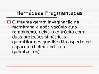 Hemáceas Fragmentadas
 O trauma geram invaginação na
  membrana e após vacúolo cujo
  rompimento deixa o eritrócito com
  duas projeções simétricas
  queratiformes que lhe dão aspecto de
  capacete (helmet cells ou
  queratócitos)
 