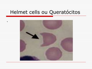 Helmet cells ou Queratócitos
.
 
