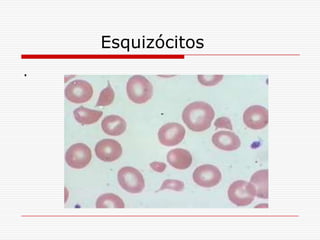 Esquizócitos
.
 