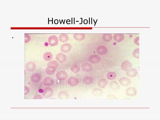 Howell-Jolly
.
 