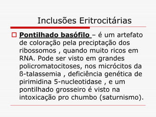 Inclusões Eritrocitárias
 Pontilhado basófilo – é um artefato
  de coloração pela preciptação dos
  ribossomos , quando muito ricos em
  RNA. Pode ser visto em grandes
  policromatocitoses, nos micrócitos da
  ß-talassemia , deficiência genética de
  pirimidina 5-nucleotidase , e um
  pontilhado grosseiro é visto na
  intoxicação pro chumbo (saturnismo).
 