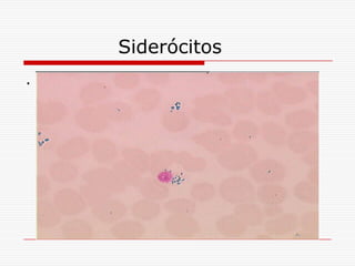 Siderócitos
.
 