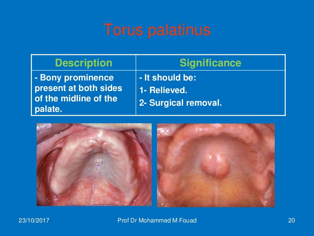 Intraoral Anatomical Landmarks