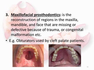 3. Maxillofacial prosthodontics: is the
reconstruction of regions in the maxilla,
mandible, and face that are missing or
defective because of trauma, or congenital
malformation etc.
• E.g. Obturators used by cleft palate patients.
11
 