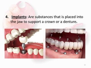 4. Implants: Are substances that is placed into
the jaw to support a crown or a denture.
12
 
