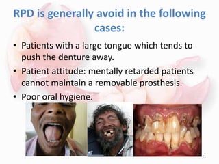 RPD is generally avoid in the following
cases:
• Patients with a large tongue which tends to
push the denture away.
• Patient attitude: mentally retarded patients
cannot maintain a removable prosthesis.
• Poor oral hygiene.
21
 