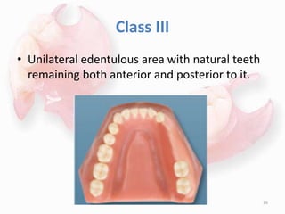 Class III
• Unilateral edentulous area with natural teeth
remaining both anterior and posterior to it.
26
 