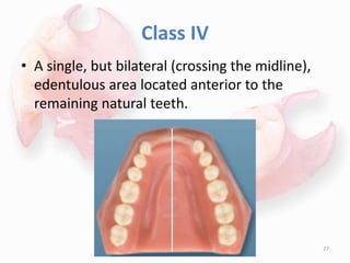 Class IV
• A single, but bilateral (crossing the midline),
edentulous area located anterior to the
remaining natural teeth.
27
 