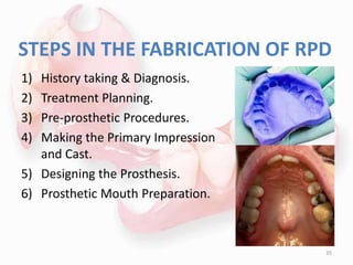 STEPS IN THE FABRICATION OF RPD
1) History taking & Diagnosis.
2) Treatment Planning.
3) Pre-prosthetic Procedures.
4) Making the Primary Impression
and Cast.
5) Designing the Prosthesis.
6) Prosthetic Mouth Preparation.
35
 