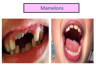 Mamelons
 