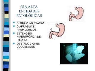OIA ALTA
ENTIDADES
PATOLÓGICAS
 ATRESIA DE PÍLORO
 DIAFRAGMAS
PREPILÓRICOS
 ESTENOSIS
HIPERTRÓFICA DE
PÍLORO
 OBSTRUCCIONES
DUODENALES
 