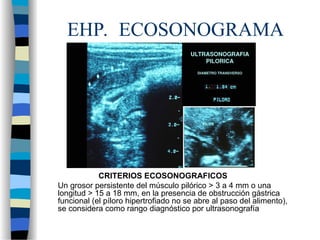 EHP. ECOSONOGRAMA
CRITERIOS ECOSONOGRAFICOS
Un grosor persistente del músculo pilórico > 3 a 4 mm o una
longitud > 15 a 18 mm, en la presencia de obstrucción gástrica
funcional (el píloro hipertrofiado no se abre al paso del alimento),
se considera como rango diagnóstico por ultrasonografía
 