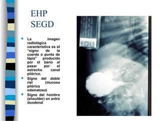 EHP
SEGD
 La imagen
radiológica
característica es el
“signo de la
cuerda o punta de
lápiz” producida
por el bario al
pasar por el
estrecho canal
pilórico.
 Signo del doble
riel (mucosa
pilórica
edematosa)
 Signo del hombro
(shoulder) en antro
duodenal
 